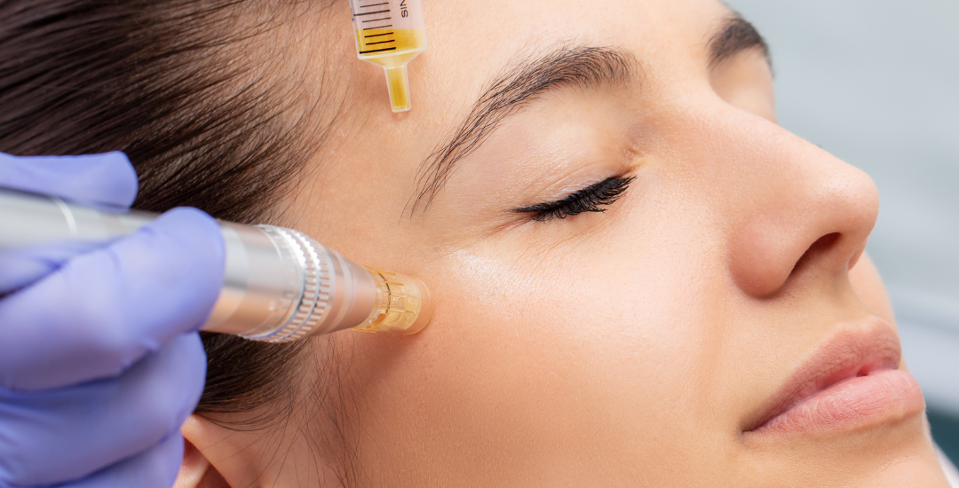 Microneedling